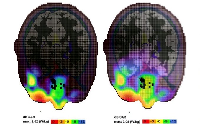 Comparison of FDTD-Calculated SAR in Adults and Children When Using a Mobile Phone at 900 and 1800 MHz Thumb