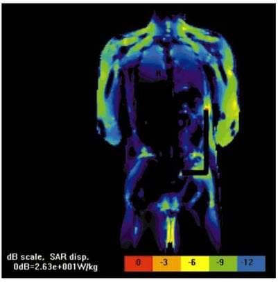 Safety of Metallic Implants in Magnetic Resonance Imaging Thumb